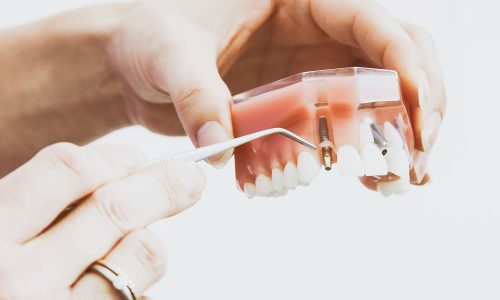 Cosa sono gli impianti dentali in zirconia